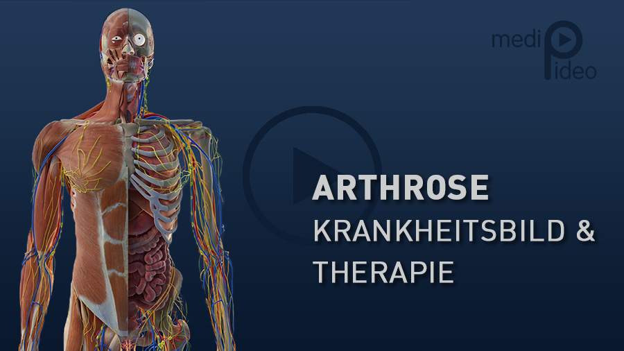 Arthrose - Krankheitsbild und Therapie